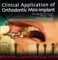 Clinical Application of Orthodontic Mini-implant (pdf)
