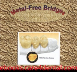 Metal free Bridges (pdf)