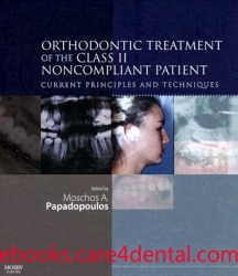 Orthodontic Treatment of the Class II Noncompliant Patient: Current Principles and Techniques (pdf)