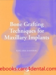 Bone Grafting Techniques for Maxillary Implants (pdf)