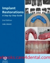 Implant Restorations: A Step-by-Step Guide (pdf)